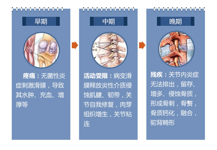 强直性脊柱炎患者病情发展示意图